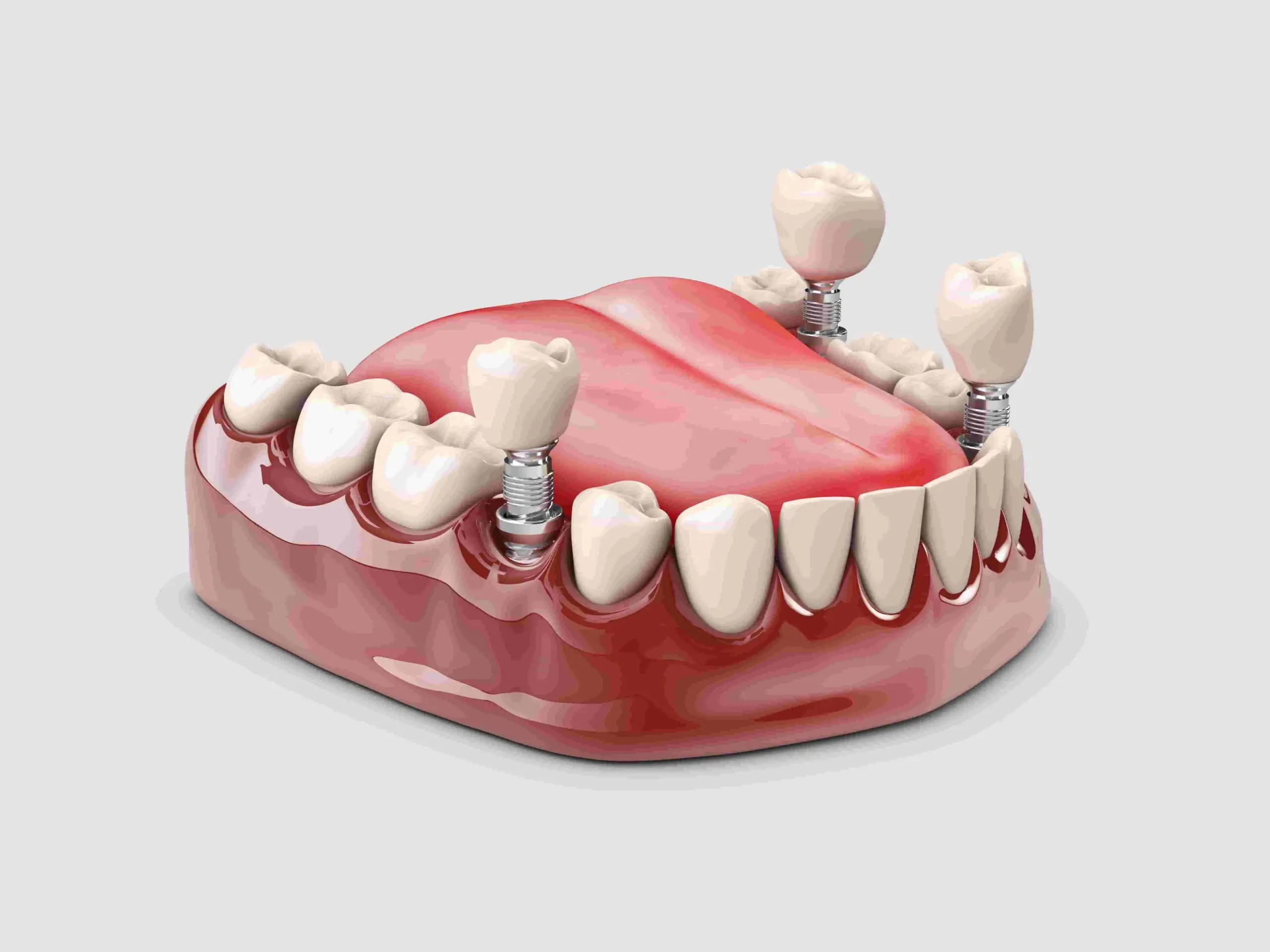 cheap dental implants